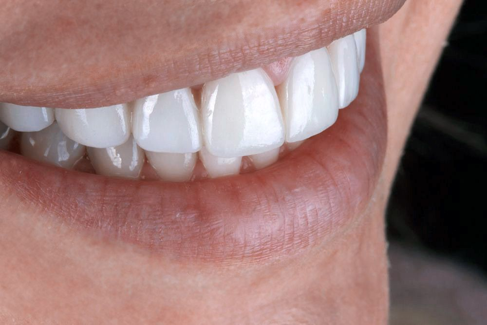 The Benefits, Uses and Preparation for Veneers the popping post